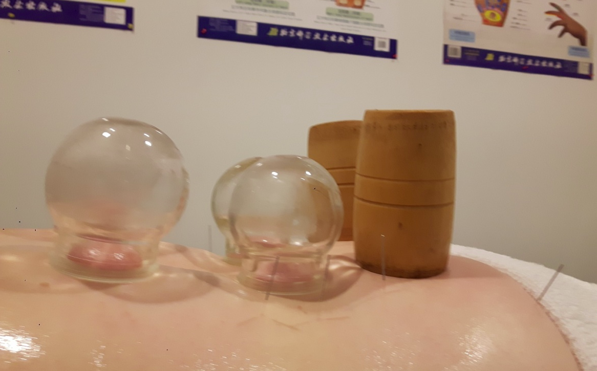 Acupuncture + Ventouses 110$ (1 heure 15 minutes)